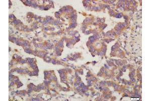 Formalin-fixed and paraffin embedded human lung carcinoma labeled with Rabbit Anti-PIG3 Polyclonal Antibody, Unconjugated (ABIN763046) at 1:200 followed by conjugation to the secondary antibody and DAB staining (MRPL41 antibody  (AA 151-250))