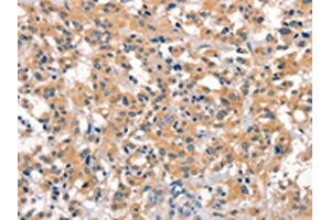The image on the left is immunohistochemistry of paraffin-embedded Human thyroid cancer tissue using ABIN7190538(EID3 Antibody) at dilution 1/15, on the right is treated with synthetic peptide. (EID3 antibody)