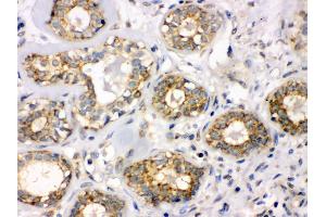 Anti- B3GNT8 Picoband antibody,IHC(P) IHC(P): Human Mammary Cancer Tissue (B3GNT8 antibody  (C-Term))