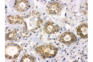 Anti- B3GNT8 Picoband antibody,IHC(P) IHC(P): Human Mammary Cancer Tissue