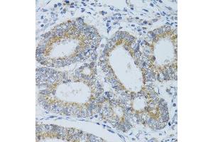 Immunohistochemistry of paraffin-embedded human colon carcinoma using DNAJC19 antibody. (DNAJC19 antibody  (AA 1-116))