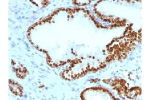 IHC testing of FFPE human prostate carcinoma with FOXA1 antibody (clone FOXA1/1241). (FOXA1 antibody)