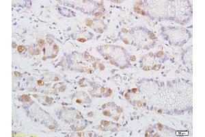 Formalin-fixed and paraffin embedded human colon carcinoma labeled with Anti-DENND2D Polyclonal Antibody, Unconjugated (ABIN1385457) at 1:200 followed by conjugation to the secondary antibody and DAB staining (DENND2D antibody  (AA 200-238))