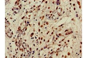 Immunohistochemistry of paraffin-embedded human lung cancer using ABIN7146768 at dilution of 1:100 (CPB2 antibody  (AA 225-372))