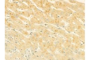 ABIN6264925 and ABIN6278520 at 1/100 staining human hepatocellular carcinoma by IHC-P.