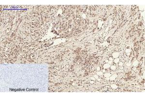 Immunohistochemical analysis of paraffin-embedded Human-kidney-cancer tissue. (Annexin a1 antibody  (AA 130-180))