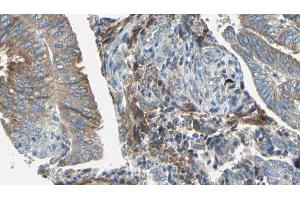 ABIN6277681 at 1/100 staining Human cervical cancer tissue by IHC-P. (OCA2 antibody  (N-Term))