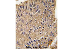 Formalin-fixed and paraffin-embedded human lung carcinomareacted with ANTXR1 polyclonal antibody , which was peroxidase-conjugated to the secondary antibody, followed by AEC staining. (ANTXR1 antibody  (Tyr382))