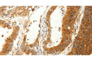 Immunohistochemistry of paraffin-embedded Human colon cancer using RARRES1 Polyclonal Antibody at dilution of 1:60 (RARRES1 antibody)