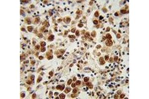 Immunohistochemistry analysis in human testis carcinoma (Formalin-fixed, Paraffin-embedded) using SOHLH1 / TEB2  Antibody (N-term), followed by peroxidase conjugation of the secondary antibody and DAB staining. (SOHLH1 antibody  (N-Term))