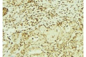 ABIN6272900 at 1/100 staining Human breast cancer tissue by IHC-P. (CEMIP antibody  (C-Term))