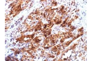 ABIN6383809 to Glypican-3 was successfully used to stain malignant cells in human hepatocellular carcinoma sections. (Recombinant Glypican 3 antibody)