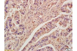 Formalin-fixed and paraffin embedded human colon carcinoma labeled with Anti-KLF2 Polyclonal Antibody, Unconjugated (ABIN680473) at 1:200, followed by conjugation to the secondary antibody and DAB staining (KLF2 antibody  (AA 251-355))