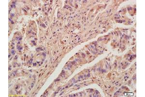 Formalin-fixed and paraffin embedded human colon carcinoma labeled with Anti-KLF2 Polyclonal Antibody, Unconjugated (ABIN680473) at 1:200, followed by conjugation to the secondary antibody and DAB staining