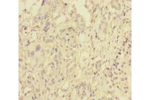 Immunohistochemistry of paraffin-embedded human pancreatic cancer using ABIN7145609 at dilution of 1:100 (Pallidin antibody  (AA 1-170))
