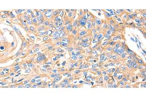 Immunohistochemistry of paraffin-embedded Human esophagus cancer using MVP Polyclonal Antibody at dilution of 1:30 (MVP antibody)