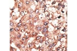IHC analysis of FFPE human hepatocarcinoma tissue stained with the BMP5 antibody (BMP5 antibody  (AA 16-46))