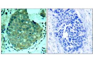 Immunohistochemical analysis of paraffin-embedded human breast carcinoma tissue, using FAK (Ab-397) antibody (E021208). (FAK antibody)