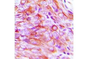 Immunohistochemical analysis of SMIT1 staining in human breast cancer formalin fixed paraffin embedded tissue section. (SLC5A3 antibody  (Center))