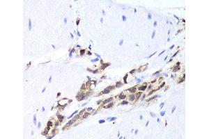 Immunohistochemistry of paraffin-embedded Human gastric cancer using TPPP3 Polyclonal Antibody at dilution of 1:100 (40x lens). (TPPP3 antibody)