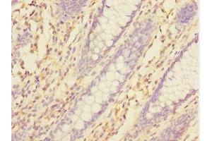 Immunohistochemistry of paraffin-embedded human colon cancer using ABIN7172004 at dilution of 1:100 (TXNDC5 antibody  (AA 1-324))