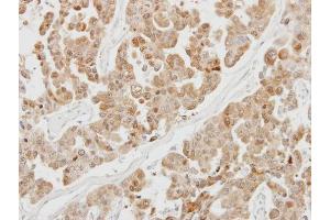 IHC-P Image Immunohistochemical analysis of paraffin-embedded OVCAR3 xenograft, using PSMB5, antibody at 1:100 dilution. (PSMB5 antibody  (C-Term))
