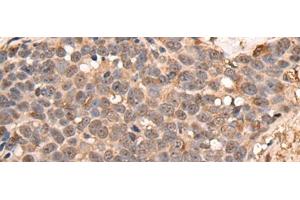 Immunohistochemistry of paraffin-embedded Human thyroid cancer tissue using ATRIP Polyclonal Antibody at dilution of 1:40(x200)