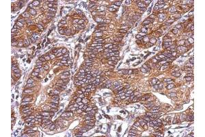 IHC-P Image Immunohistochemical analysis of paraffin-embedded human colon carcinoma, using Activin A Receptor Type IC, antibody at 1:500 dilution. (ACVR1C/ALK7 antibody  (Center))