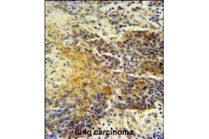 MRPS24 antibody immunohistochemistry analysis in formalin fixed and paraffin embedded human lung carcinoma followed by peroxidase conjugation of the secondary antibody and DAB staining. (MRPS24 antibody  (AA 21-50))