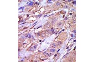Formalin-fixed and paraffin-embedded human cancer tissue reacted with the primary antibody, which was peroxidase-conjugated to the secondary antibody, followed by DAB staining. (CK1 epsilon antibody  (C-Term))