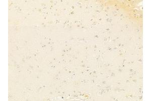 ABIN6261830 and ABIN6278360 at 1/100 staining human glioblastoma by IHC-P. (TLS/FUS (C-Term) antibody)