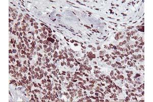 Immunohistochemical staining of paraffin-embedded Adenocarcinoma of Human breast tissue using anti-HOXC11 mouse monoclonal antibody.