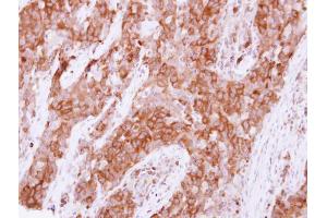 IHC-P Image Immunohistochemical analysis of paraffin-embedded human lung papillory adenocarcinoma, using Pez, antibody at 1:500 dilution.