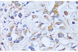Immunohistochemistry of paraffin-embedded Human breast cancer using ACADSB Polyclonal Antibody at dilution of 1:100 (40x lens).
