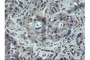 Immunohistochemical staining of paraffin-embedded Carcinoma of liver using anti-APOM (ABIN2452530) mouse monoclonal antibody. (Apolipoprotein M antibody  (AA 23-188))