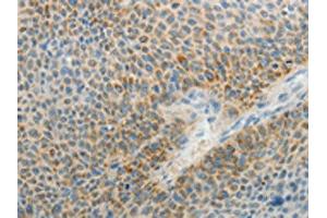 The image on the left is immunohistochemistry of paraffin-embedded Human liver cancer tissue using ABIN7189711(AGAP1 Antibody) at dilution 1/25, on the right is treated with synthetic peptide. (AGAP1 antibody)