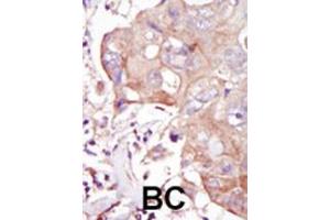 Formalin-fixed and paraffin-embedded human cancer tissue reacted with the primary antibody, which was peroxidase-conjugated to the secondary antibody, followed by DAB staining. (MAP4K3 antibody  (C-Term))