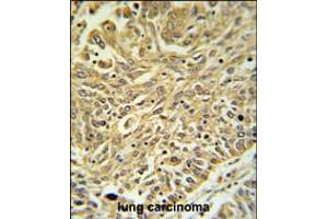 GSTK1 Antibody IHC analysis in formalin fixed and paraffin embedded lung carcinoma followed by peroxidase conjugation of the secondary antibody and DAB staining.