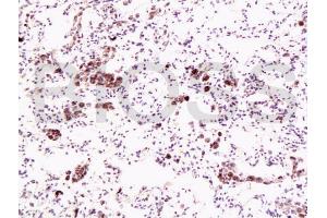 Formalin-fixed and paraffin embedded human lung carcinoma labeled with Anti-Dnmt1 Polyclonal Antibody, Unconjugated (ABIN671796) at 1:200, followed by conjugation to the secondary antibody and DAB staining (DNMT1 antibody  (AA 21-120))