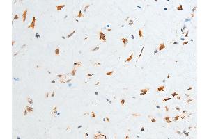 ABIN6267250 at 1/100 staining human glioma tissue sections by IHC-P. (CHEK2 antibody  (pThr387))