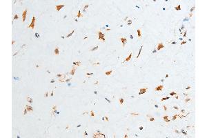 ABIN6267250 at 1/100 staining human glioma tissue sections by IHC-P.