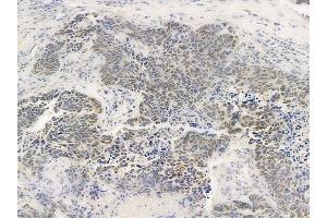 ABIN6259055 and ABIN6275393 at 1/100 staining human large cell lung carcinoma by IHC-P.