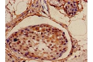 Immunohistochemistry of paraffin-embedded human breast cancer using ABIN7160901 at dilution of 1:100 (NDUFA4L2 antibody  (AA 48-87))