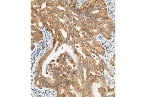 (ABIN657450 and ABIN2846476) staining CTAG1A in human gastric carcinoma tissue sections by Immunohistochemistry (IHC-P - paraformaldehyde-fixed, paraffin-embedded sections).