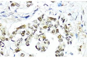 Immunohistochemistry of paraffin-embedded Human lung cancer using SUMO1 Polyclonal Antibody at dilution of 1:200 (40x lens). (SUMO1 antibody)