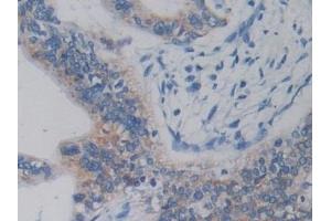 Detection of DCLK1 in Human Prostate Tissue using Polyclonal Antibody to Doublecortin Like Kinase 1 (DCLK1) (DCLK1 antibody  (AA 390-647))