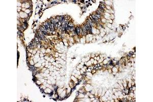 IHC-P: SOD2 antibody testing of human intestinal cancer tissue