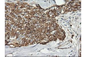 Immunohistochemical staining of paraffin-embedded Adenocarcinoma of Human breast tissue using anti-PFKP mouse monoclonal antibody. (PFKP antibody)