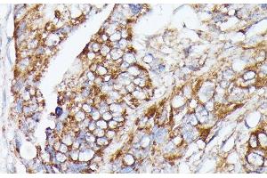 Immunohistochemistry of paraffin-embedded Human colon carcinoma using NUBP1 Polyclonal Antibody at dilution of 1:100 (40x lens). (NUBP1 antibody)