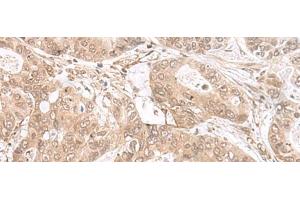 Immunohistochemistry of paraffin-embedded Human gastric cancer tissue using ETV3 Polyclonal Antibody at dilution of 1:25(x200) (ETV3 antibody)